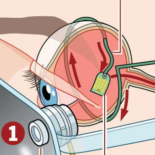5W Samples - Retinal Implant